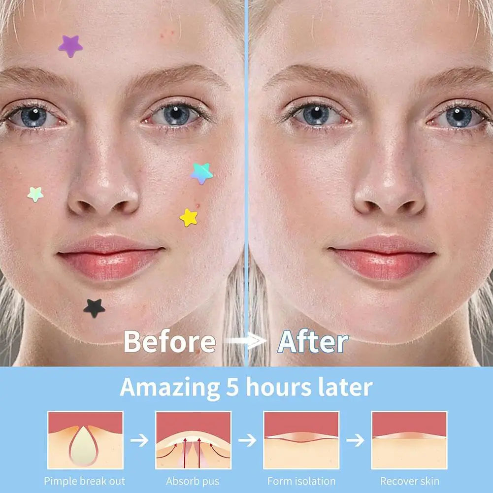 Colorful Star Pimple Patch – Acne Spot Stickers