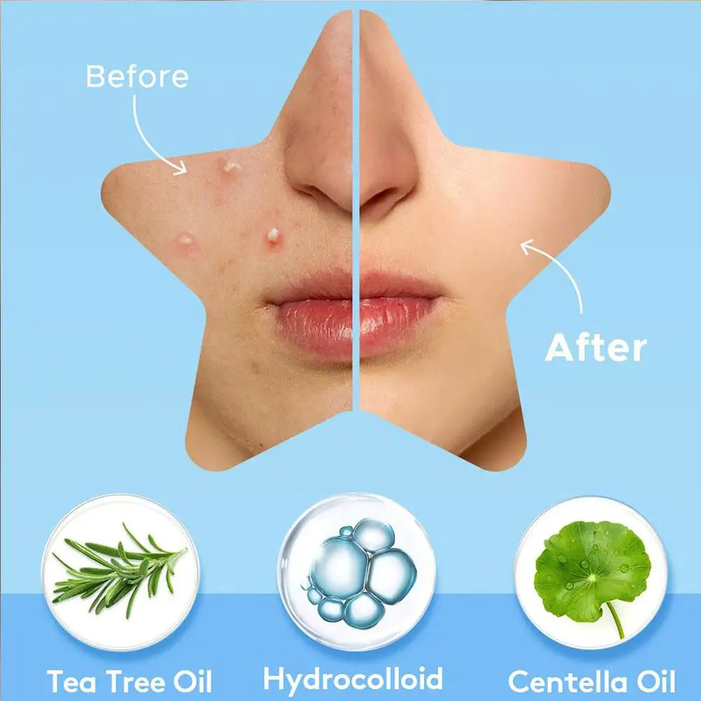 Colorful Star Pimple Patch – Acne Spot Stickers